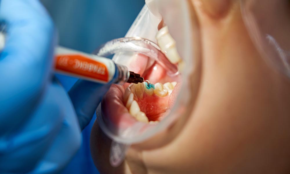 Dental fillings Perth