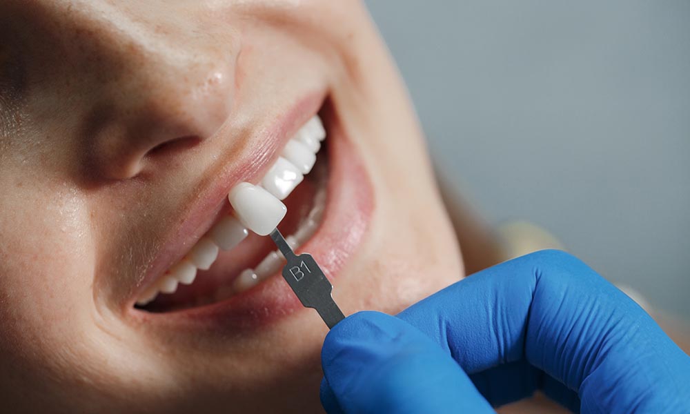 Veneers Perth