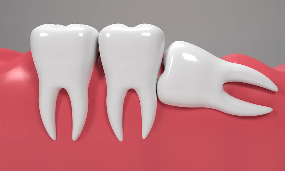 how to speed up wisdom teeth recovery