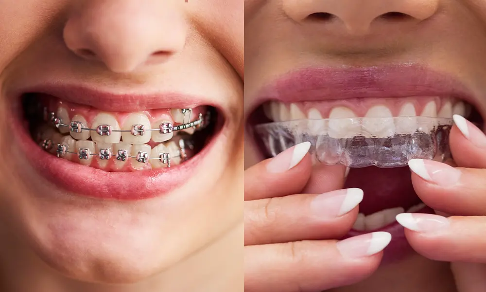 Braces Perth