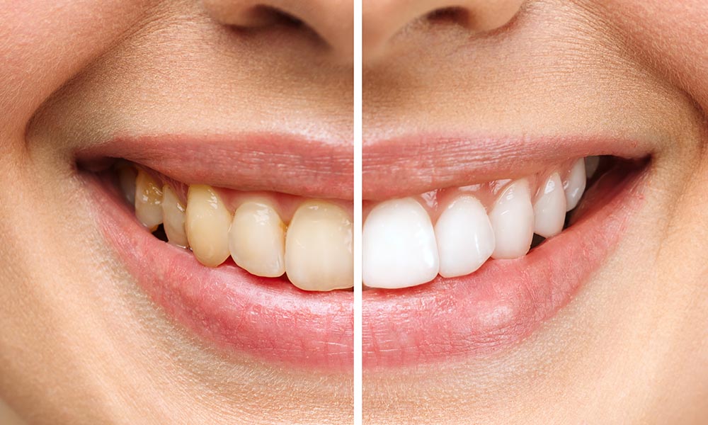 Teeth whitening dentist