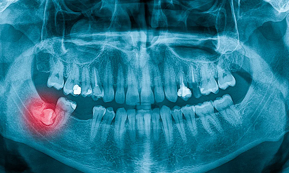when do wisdom teeth come through