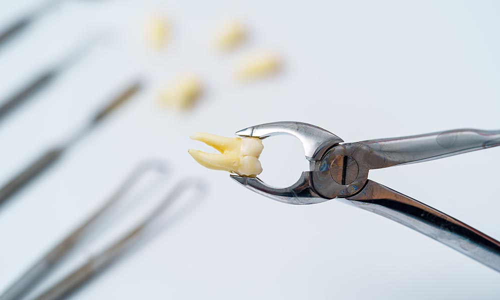 Wisdom teeth dentist Perth
