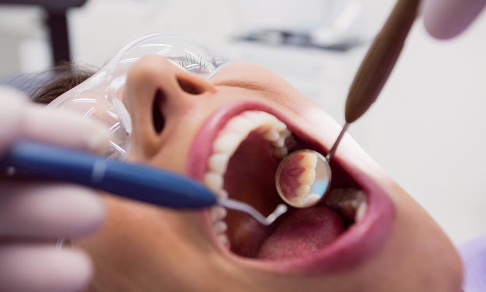 dental fillings
