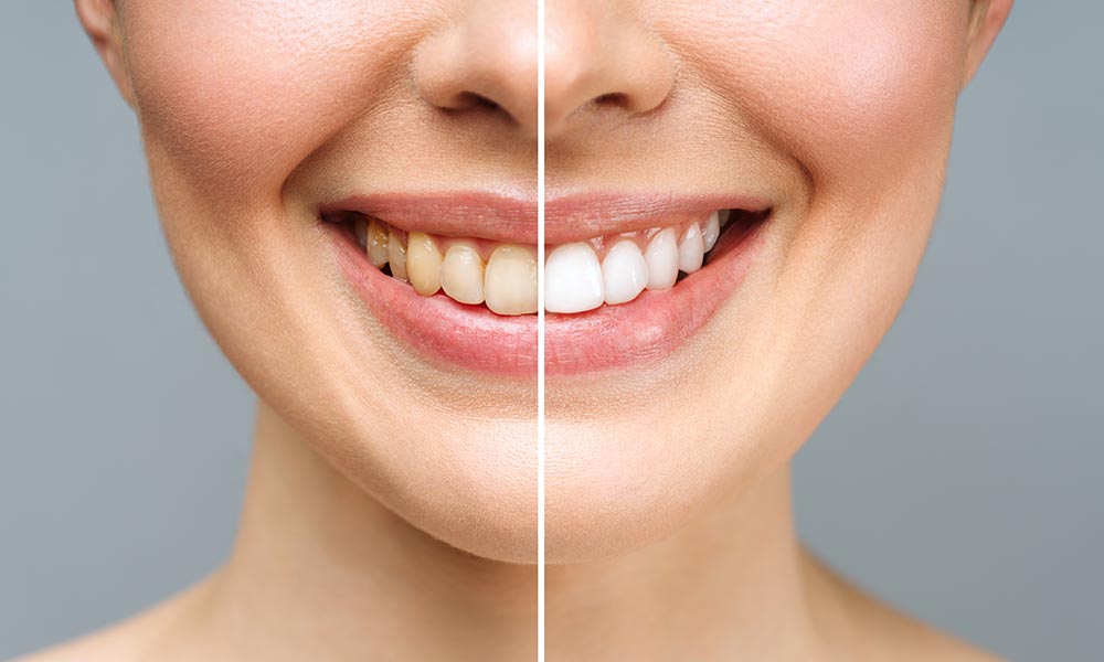 how long does teeth whitening last