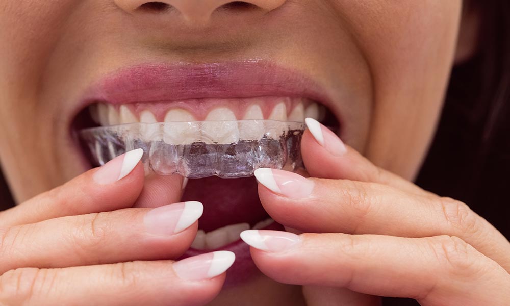 invisalign vs braces
