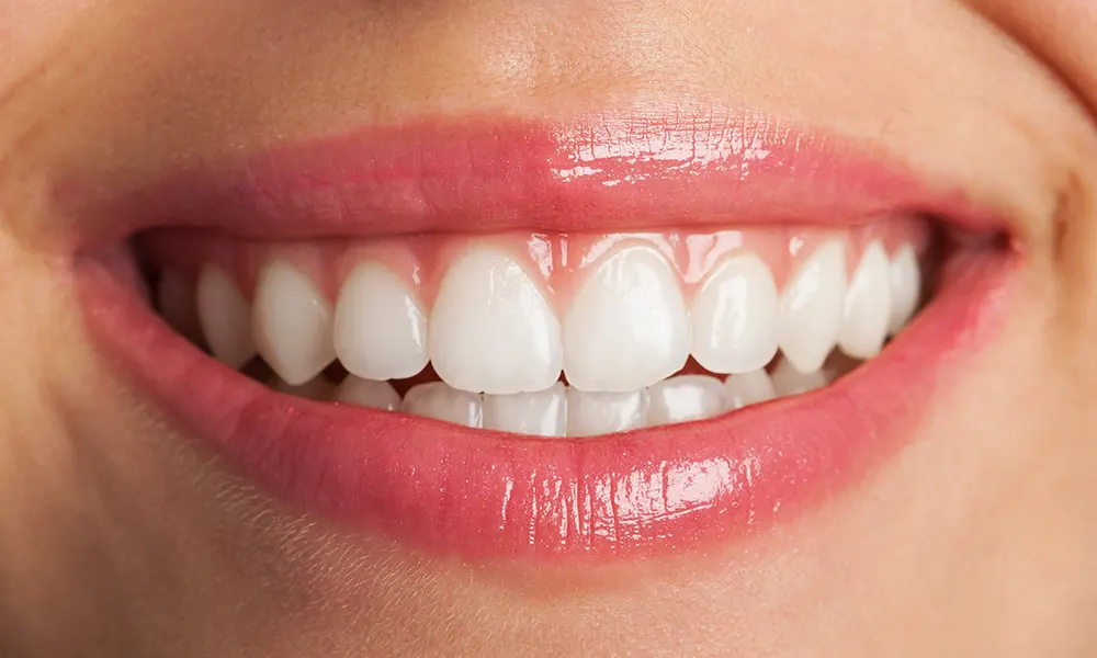 do veneers ruin your teeth